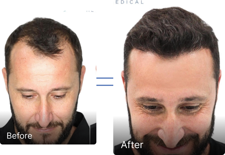 Before and after result 5